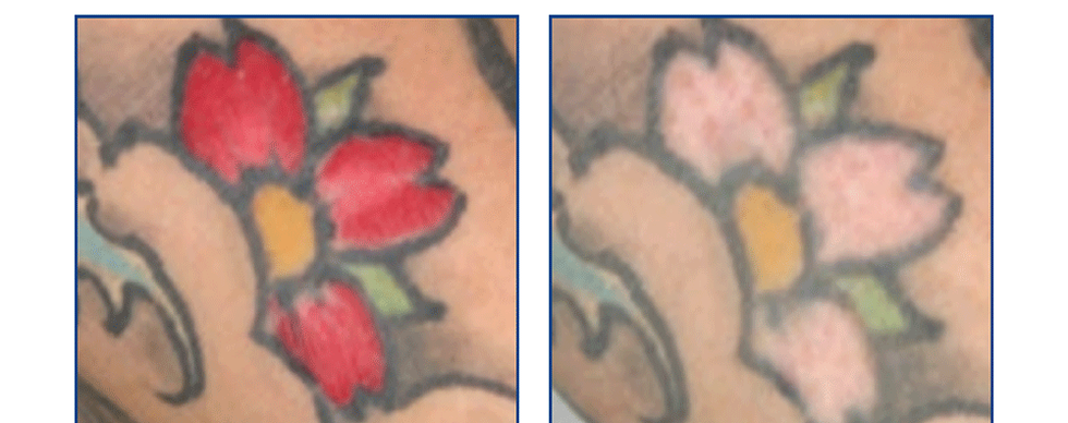 Skin area with tattoo and without tattoo after administering laser skin tattoo removal treatment