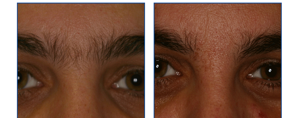 Laser hair removal between the eyebrows area showing results before and after administering the treatment