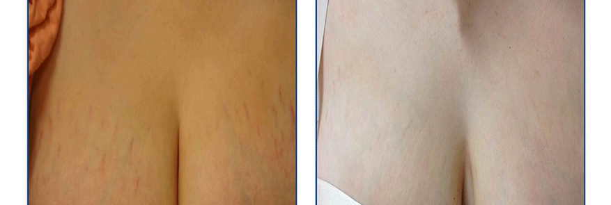 Stretch Marks Removal before and after photo