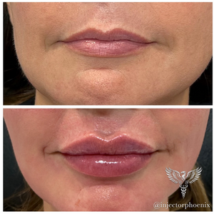 ORLANDO LIP FILLER
