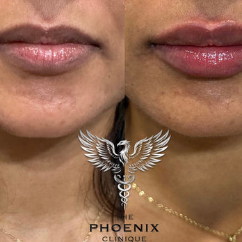 Best Lip Injector in Orlando, FL at The Phoenix Clinique