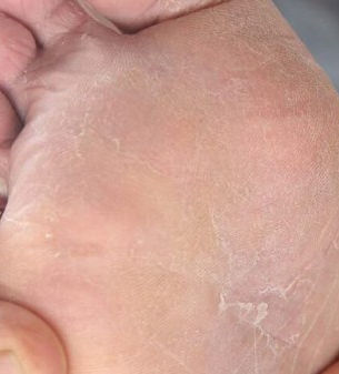 What Are the Signs That Your Athlete's Foot Requires a Doctor's Visit?