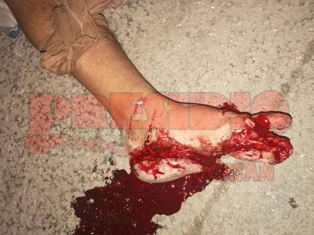 "TERMINA CON PIE DESPEDAZADO"