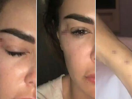 “Moretones, por cirugías estéticas”: Giovanni Medina reaccionó a las fotos de Ninel Conde con marcas