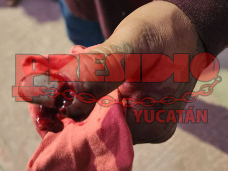 HOMBRE PIERDE DEDOS TRAS EXPLOTARLE UN VOLADOR