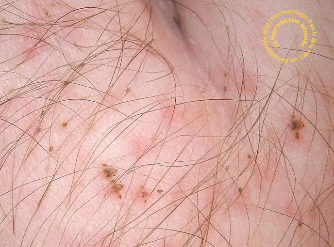 PEDICULOSE INGUINALE