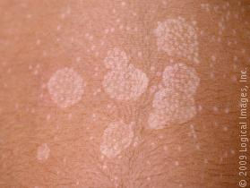 PITYRIASIS VERSICOLOR