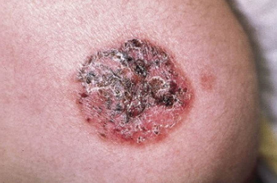 CARCINOME BASOCELLULAIRE