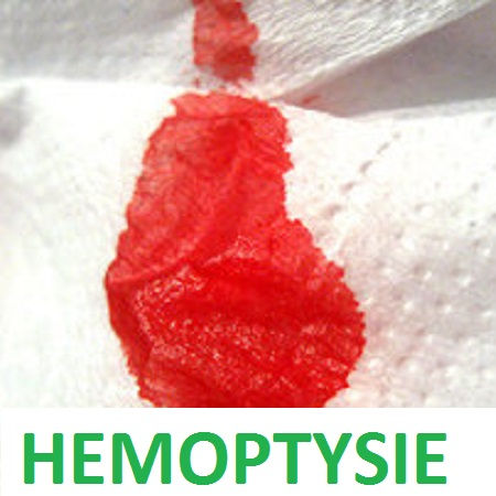 HEMOPTYSIE
