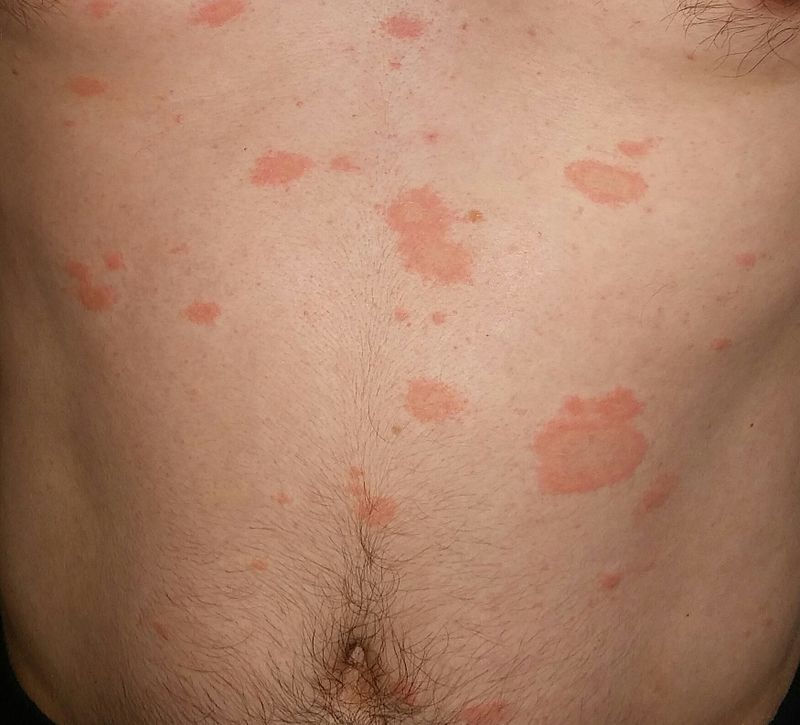 PITYRIASIS ROSE GIBERT