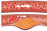 Ipercolesterolemia