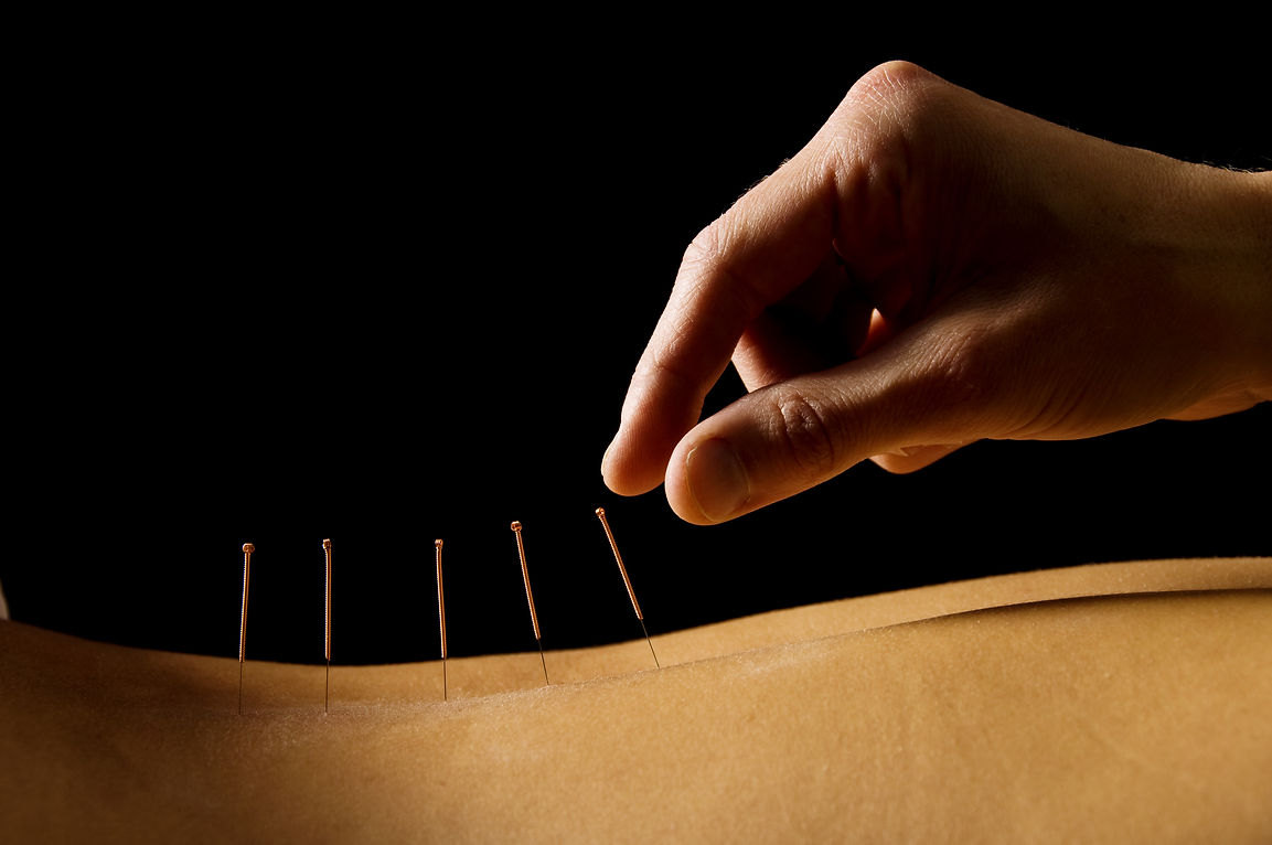 Acupuncture services at DUR1 HEALTH