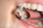 Enamel Erosion