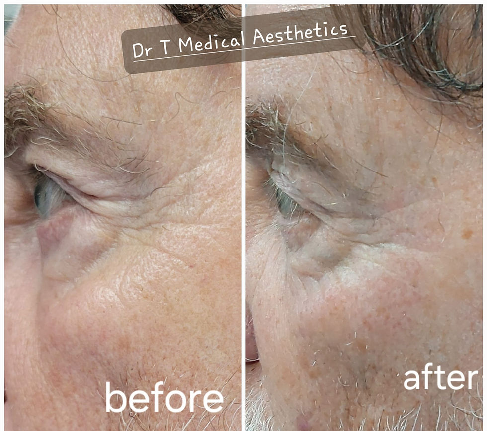 Before and after PLEXR Plasma treatment for hooded eyes.