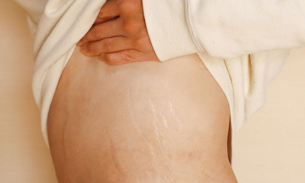 PLEXR treatment for scars and stretch marks