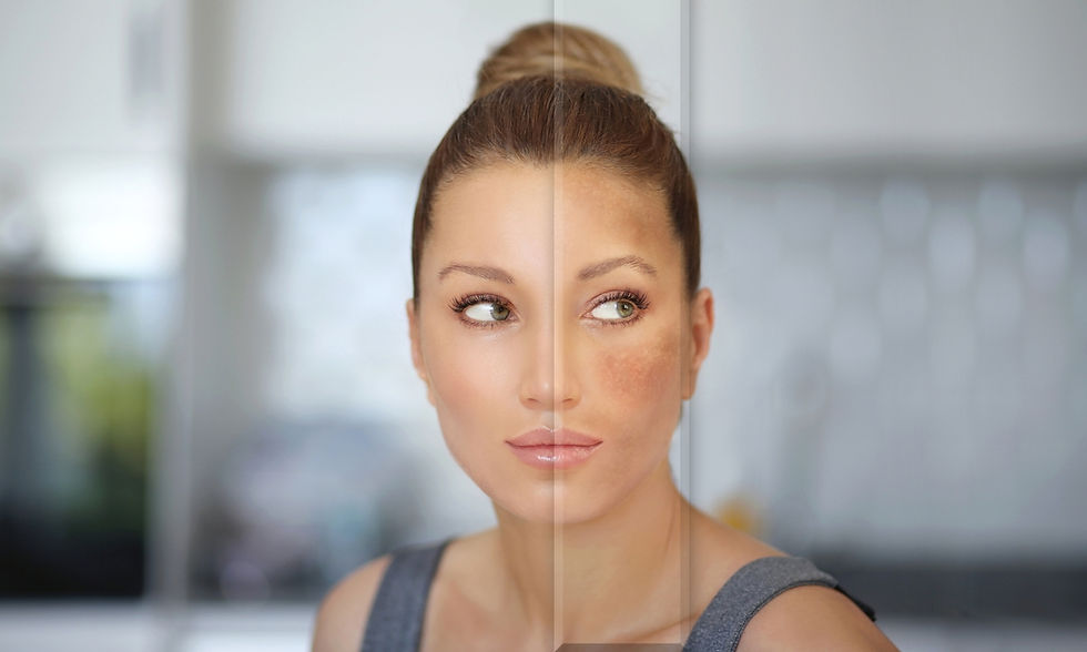 Treatment for excess sweating in London Ontario