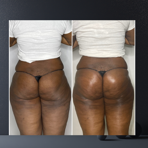 BBL Brazilian butt lift non-surgical before after results body contouring Philadelphia