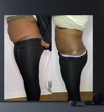 BBL non-surgical butt enhancement before and after Bodied Boss Studio