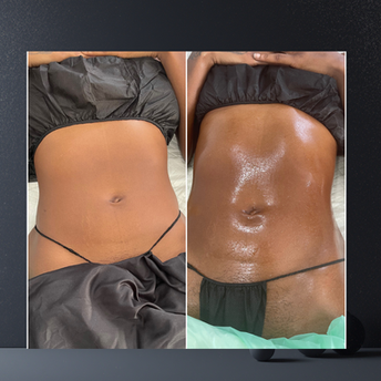 Stomach fat reduction before and after body sculpting Bodied Boss Studio