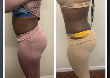 Body contouring results stomach and hip slimming non-invasive treatment Philadelphia