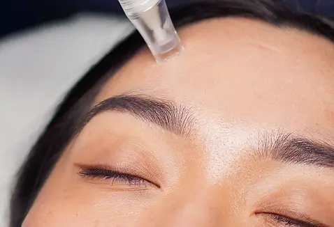Close-up of microneedling procedure using a SkinPen device – stimulates collagen production for smoother, firmer skin.