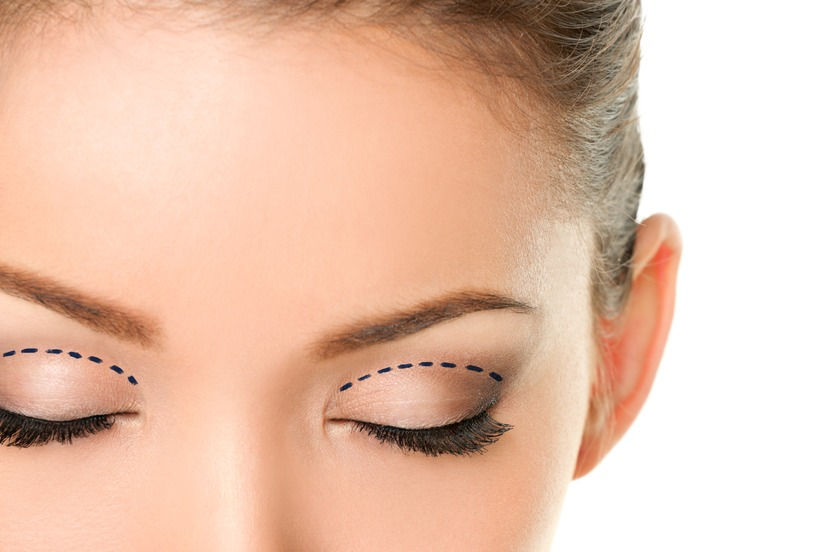 Cosmetic Eyelid Surgery