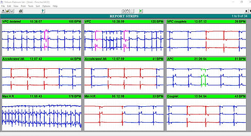 Laudo Holter ECG 24hs trechos.jpg