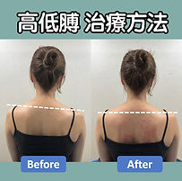 高低膊 物理治療 治療方法