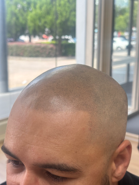 Completed SMP session for Male Balding - Toowoomba