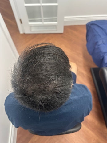 Man's head from above post SMP density Treatment by @SMPbyJason