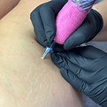 Scars & Stretch Mark Tattoo