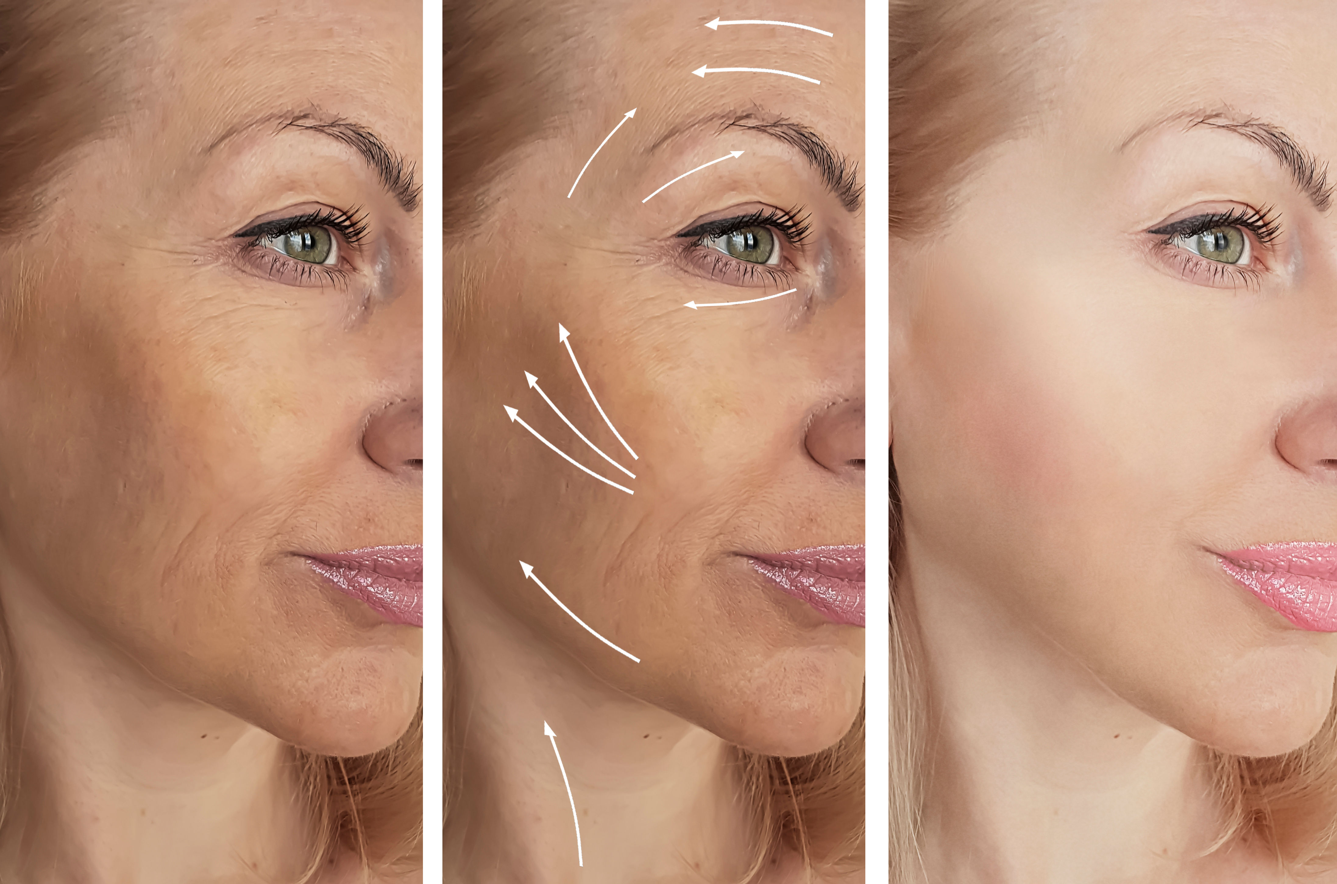 90 Day Anti Aging Treatment Package