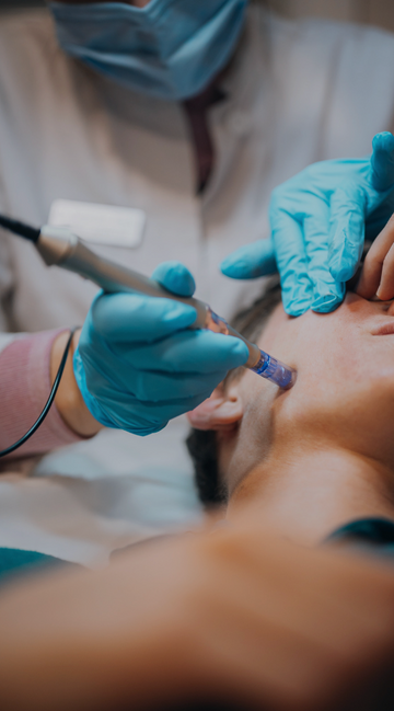 Vivace /Microneedling