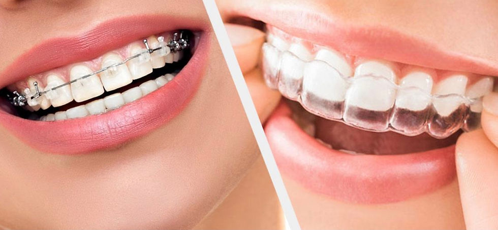 braces-aligners-invisalign