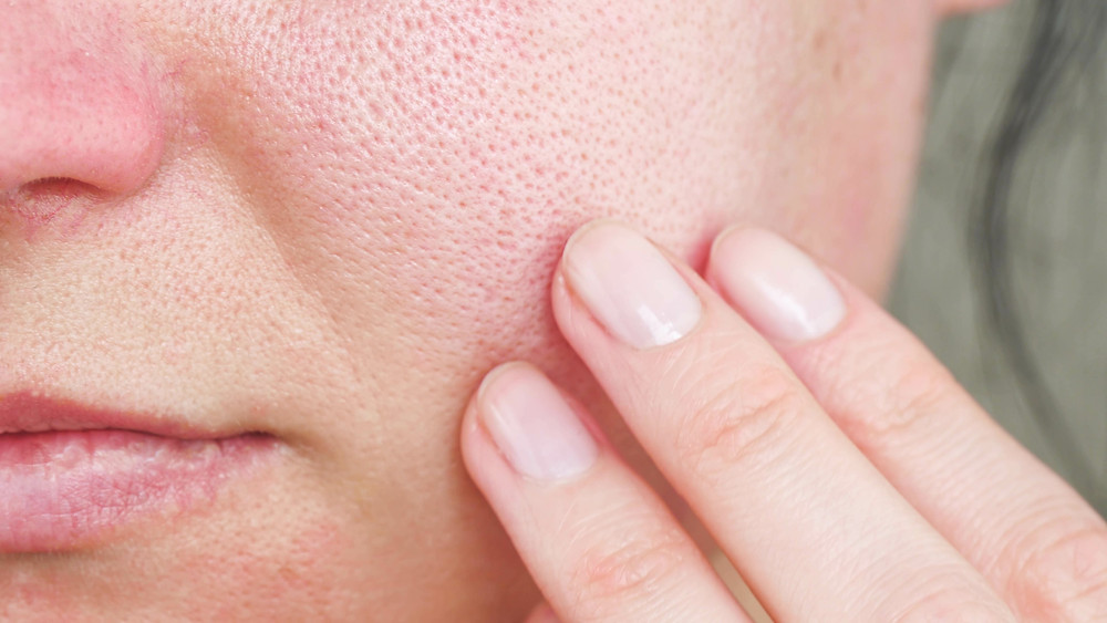 skin texture and the formation of acne