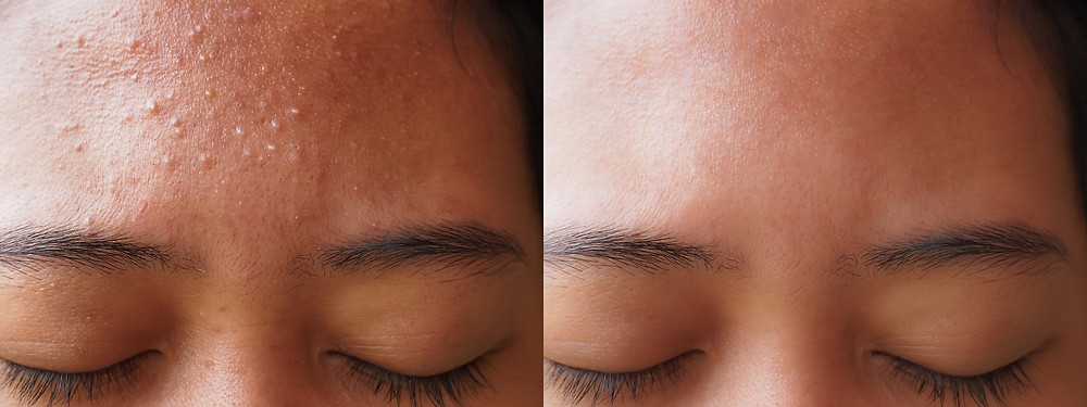 yeast infection Malassezia acne