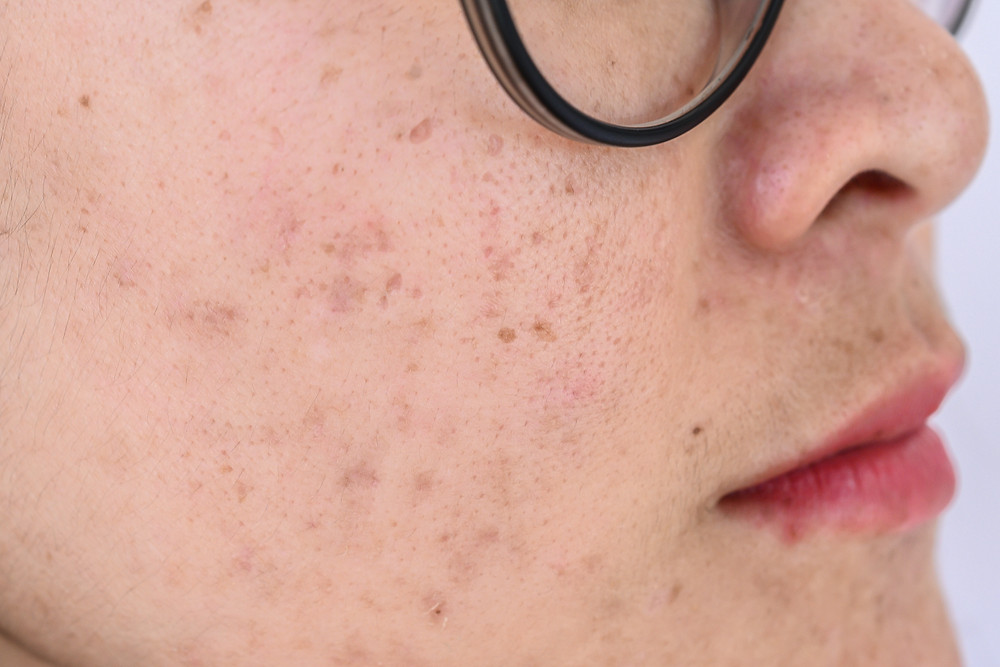 best facials for acne