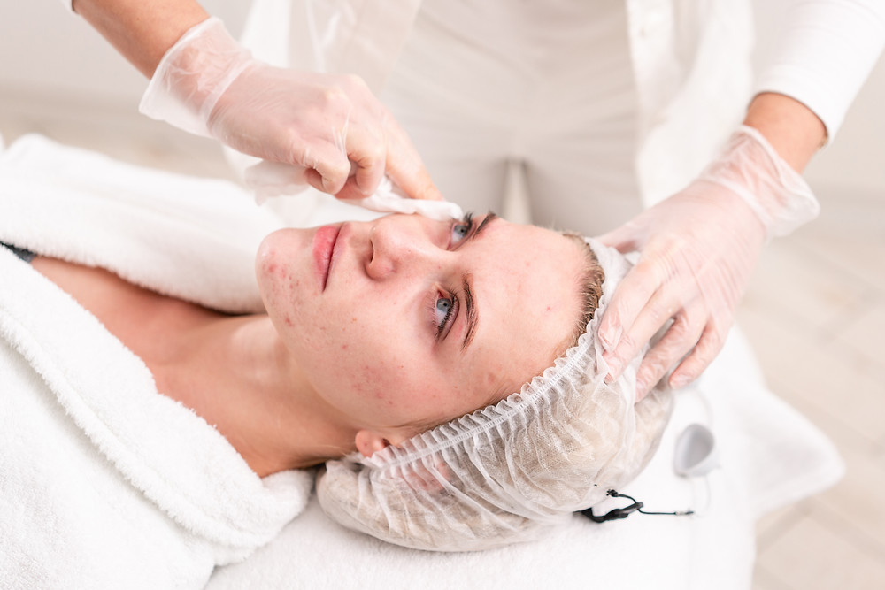 how to treat acne caused by wearing a mask