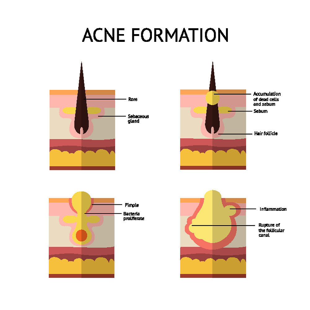 acne formation