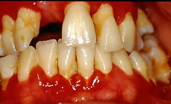 gingivitis_high_pt.jpg