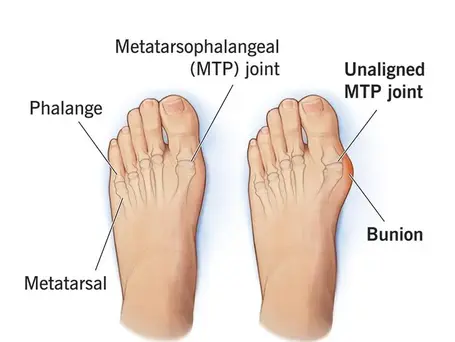 suure varba nukk ehk bunion ehk hallux valgus