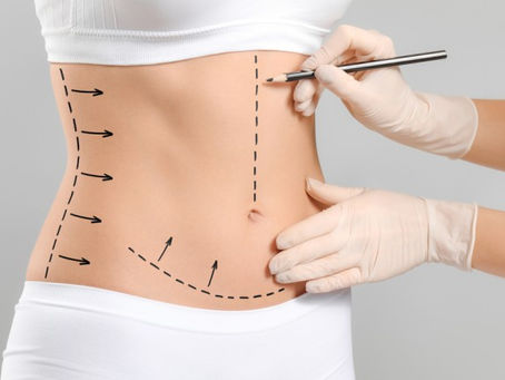 How Liposuction Works: Step-by-Step Process in Islamabad