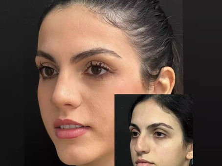 Why Rhinoplasty is One of the Most Popular Cosmetic Surgeries in Islamabad