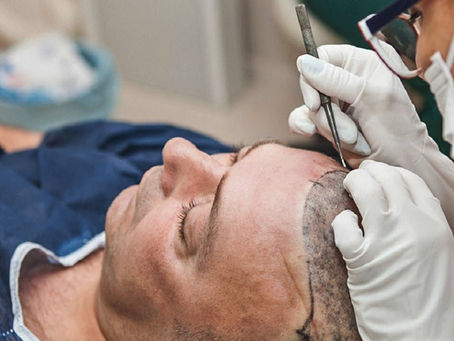 Signs of a Successful Hair Transplant