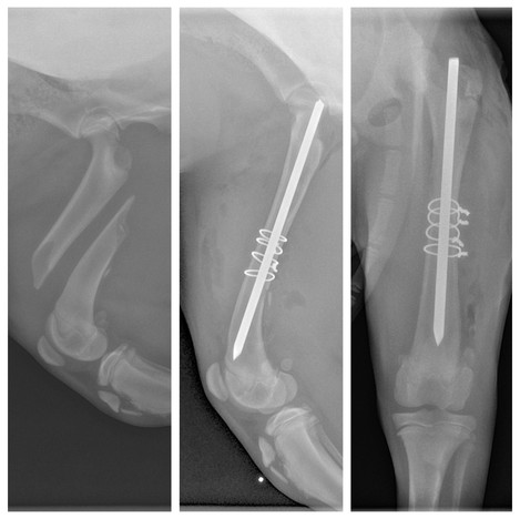 Femoral Long Oblique Fracture