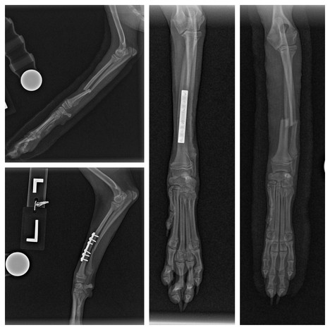 Mid Radial Ulnar Fracture