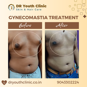 Gynecomastia Treatment at DR Youth Clinic in Anna Nagar East, Chennai