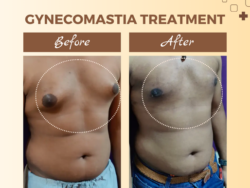 Gynecomastia Treatment at DR Youth Clinic in Anna Nagar East, Chennai