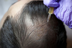 PRP treatment for hair loss