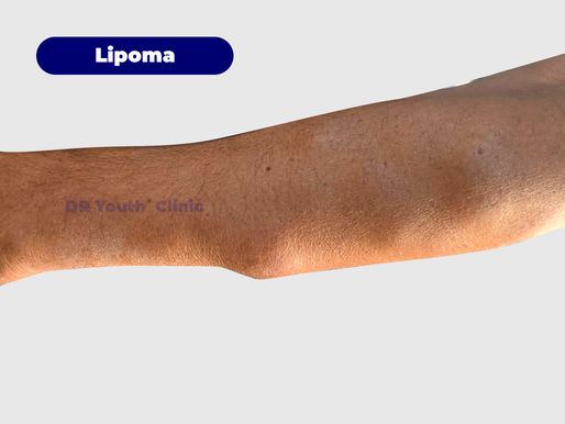 Lipomas Removal Treatment at Affordable Price
